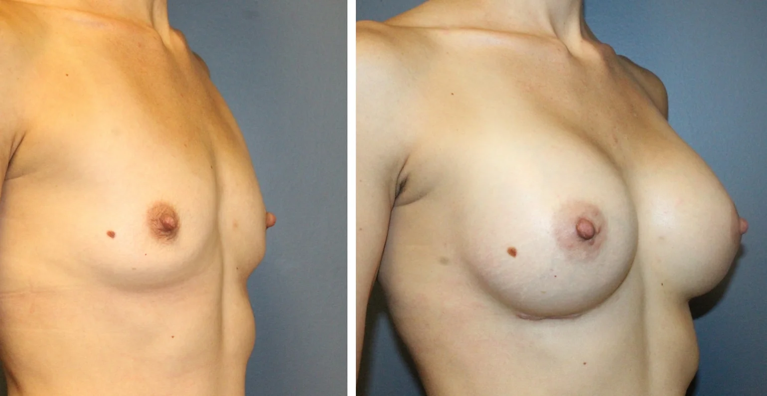 Breast Augmentation