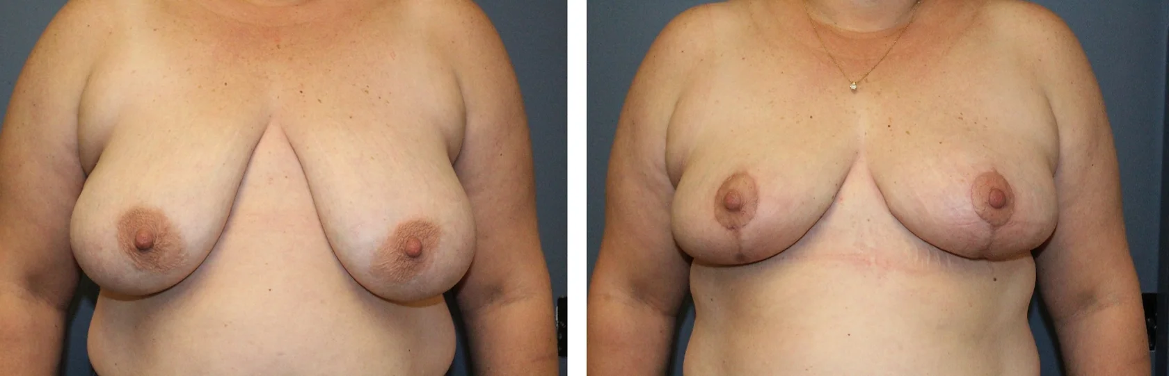 Breast Lift