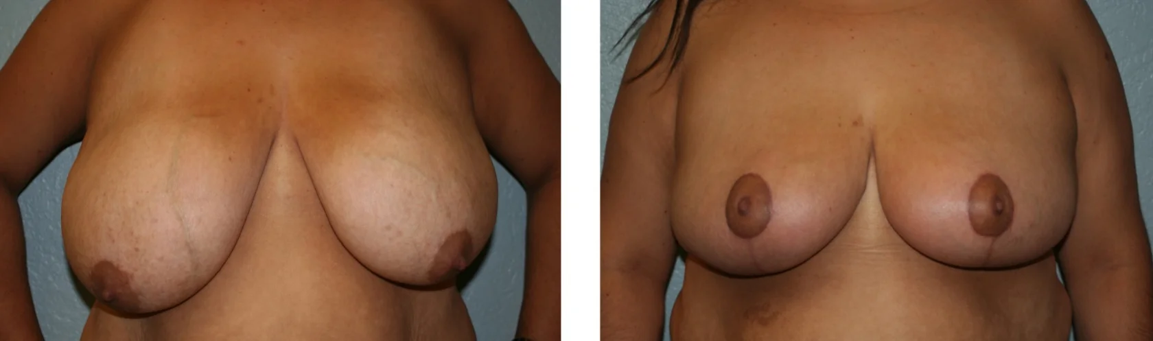 Breast Reduction