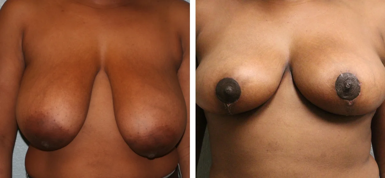 Breast Reduction