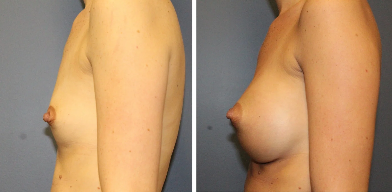 Breast Augmentation