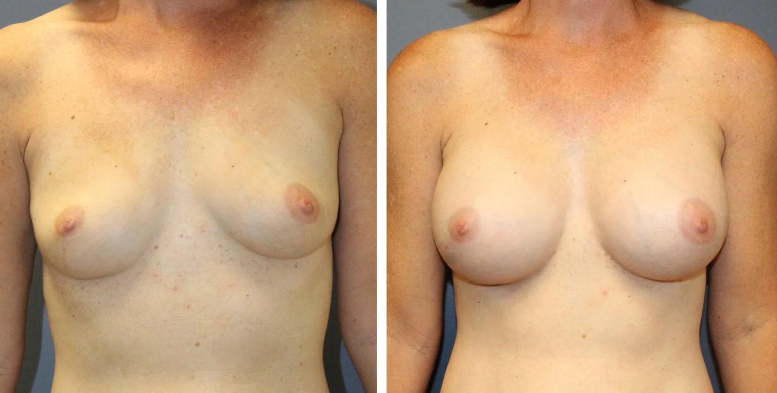 Breast Augmentation