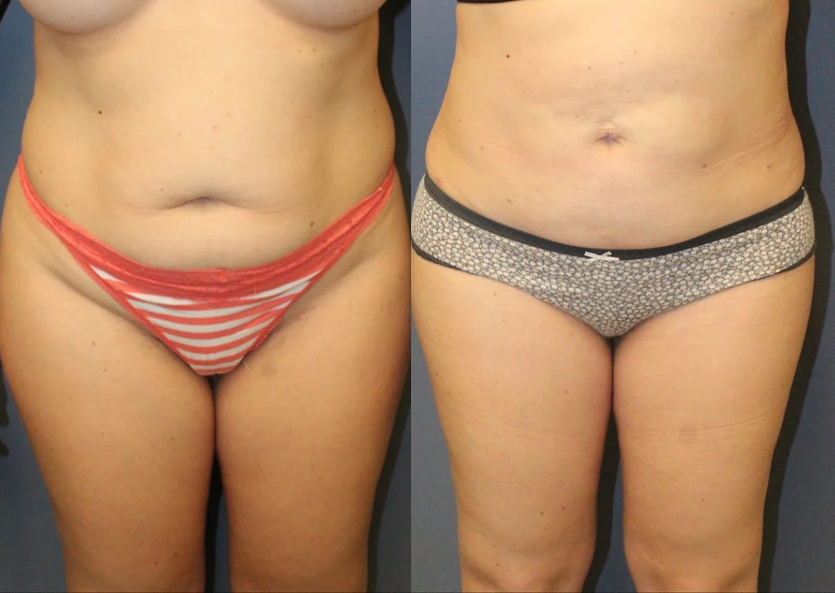 High-Definition Liposuction in Orlando, FL - Plastic Surgery in