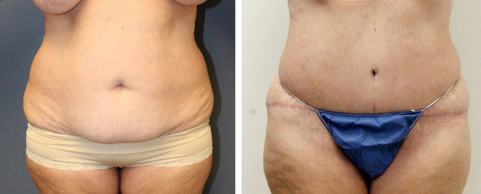 Tummy Tuck