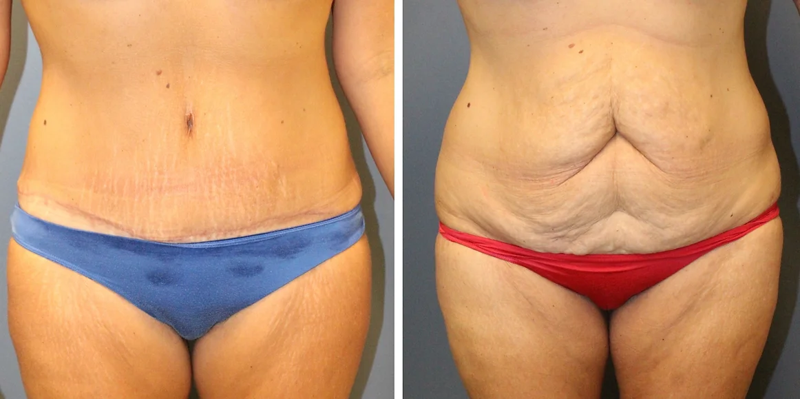 Tummy Tuck