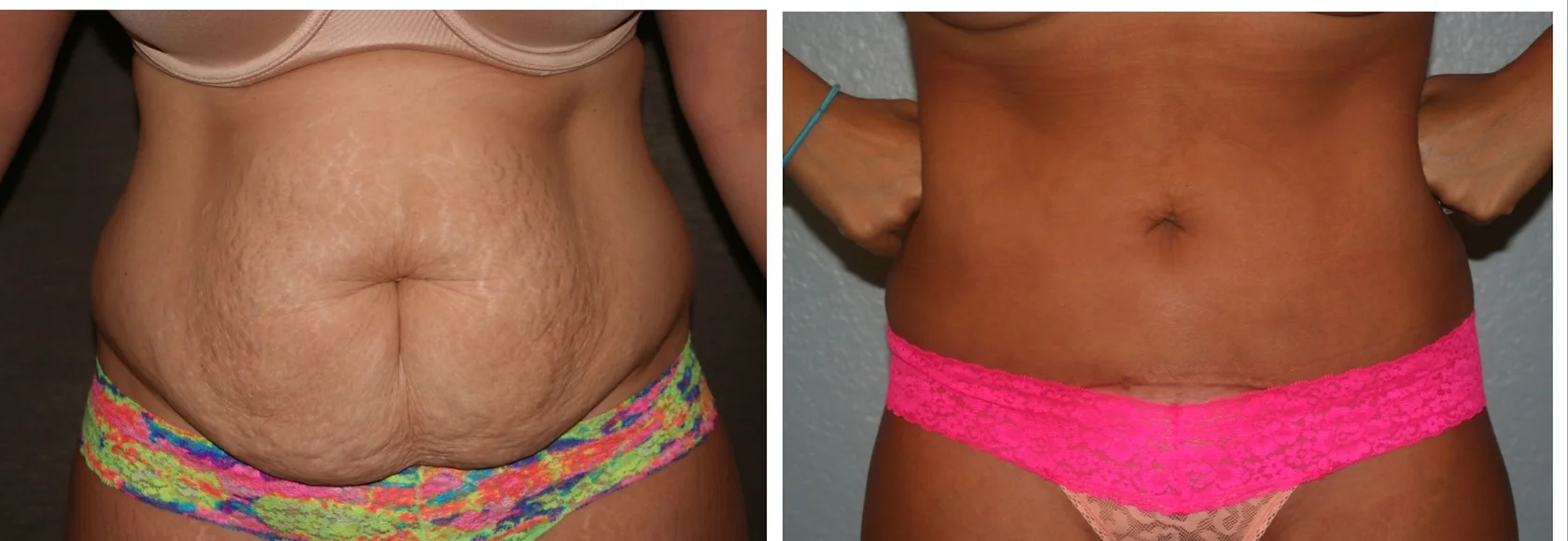 Tummy Tuck