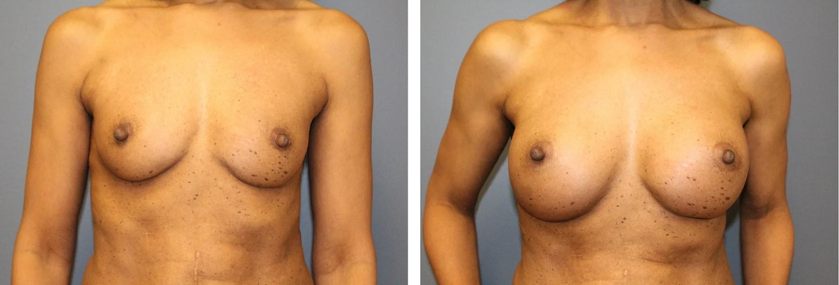 Breast Augmentation