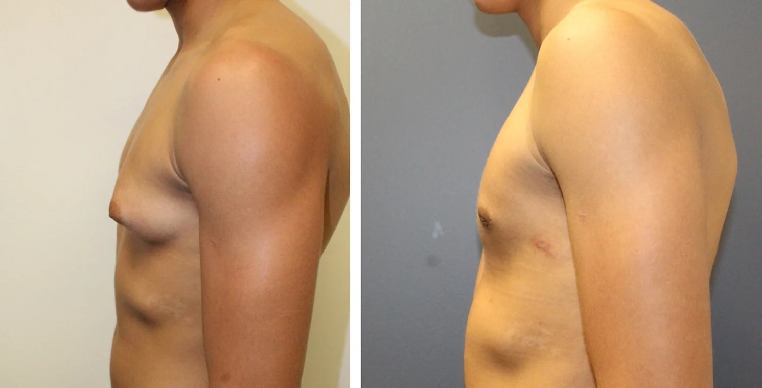 Gynecomastia