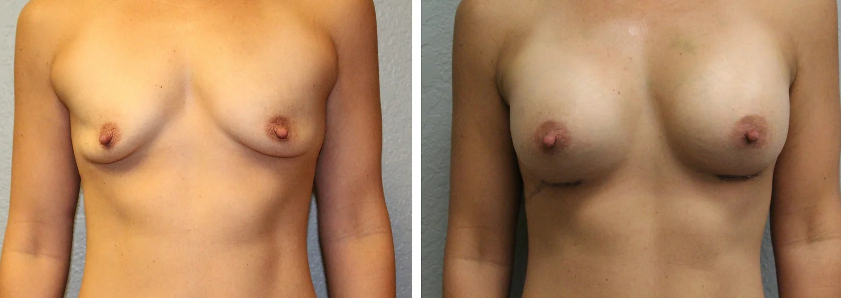 Breast Augmentation