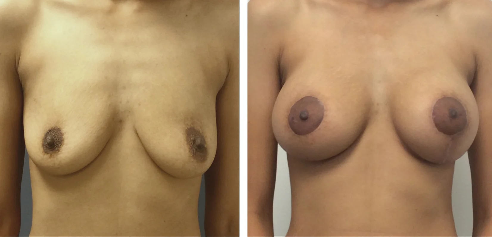 Breast Augmentation