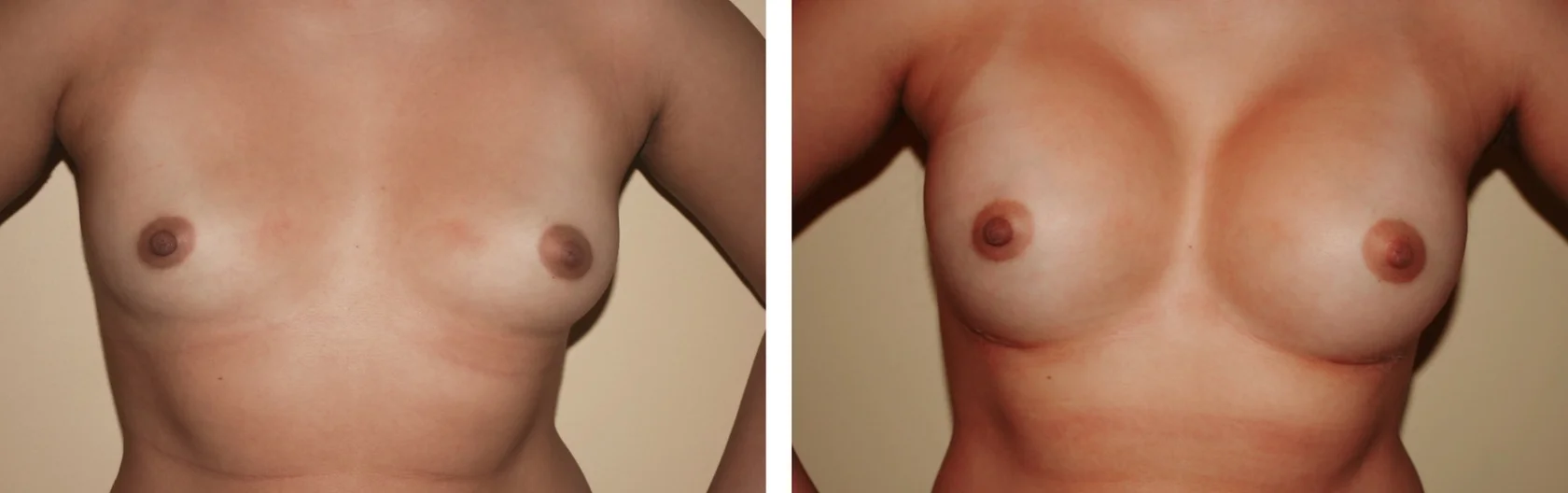 Breast Augmentation