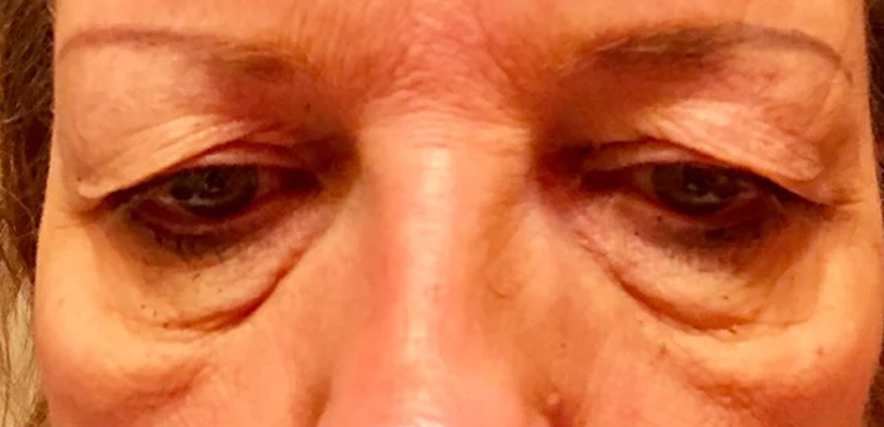 Blepharoplasty