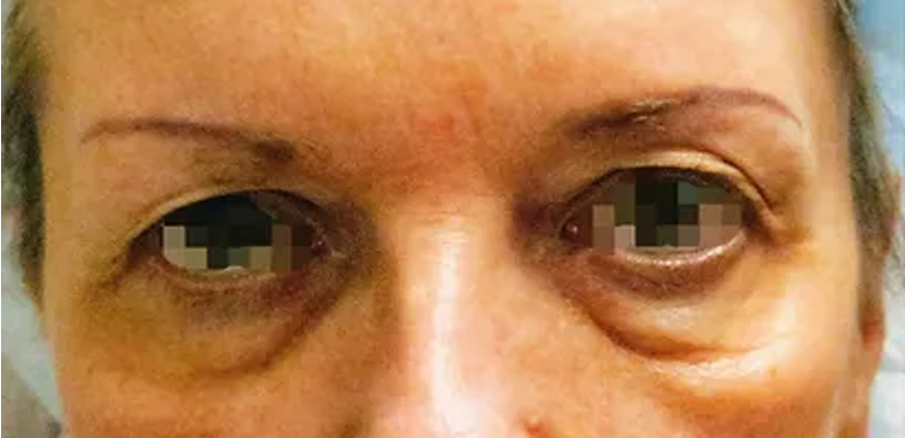 Blepharoplasty