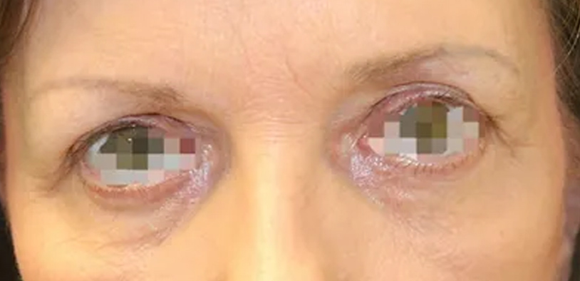 Blepharoplasty