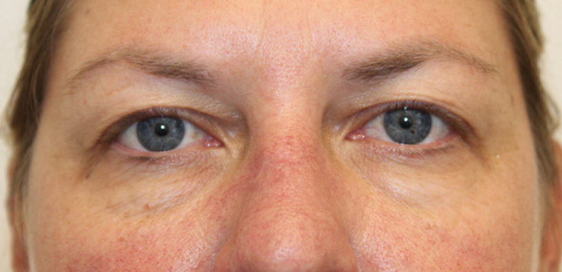 Blepharoplasty