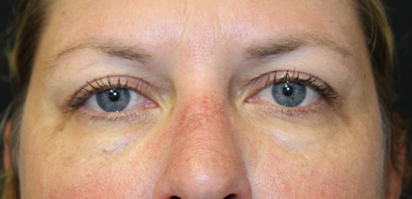 Blepharoplasty