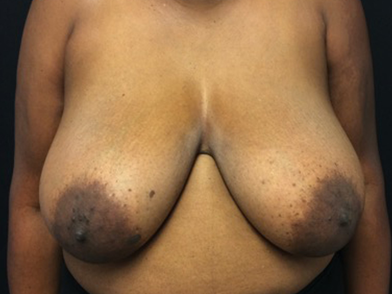 Breast Reduction