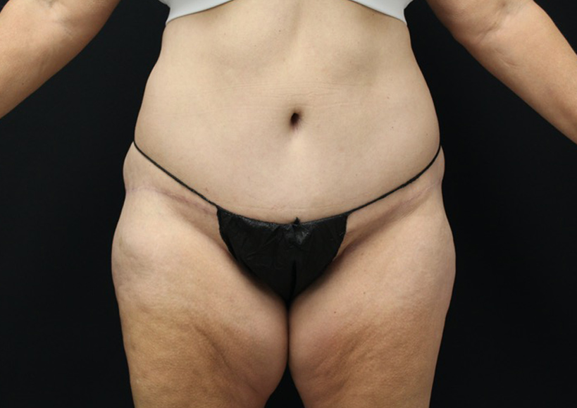 Tummy Tuck