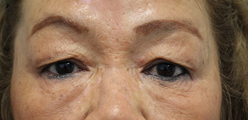 Blepharoplasty