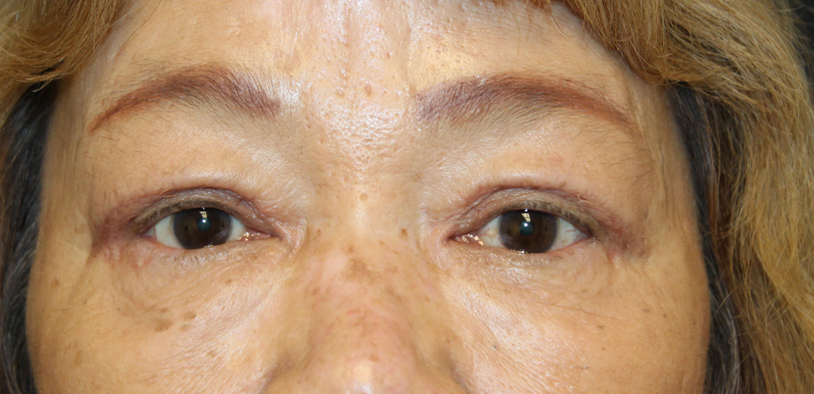 Blepharoplasty