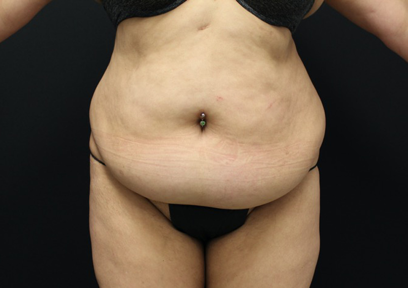 Tummy Tuck