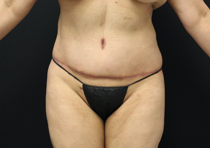 Tummy Tuck