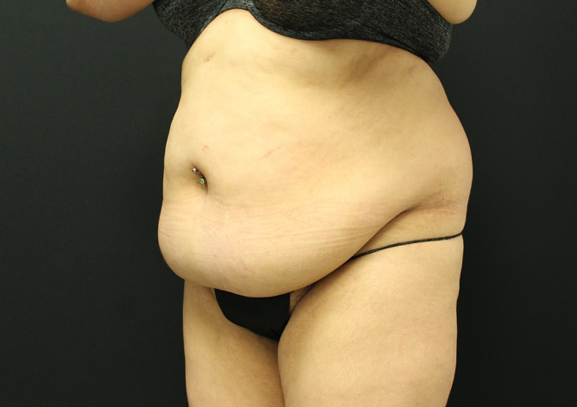 Tummy Tuck