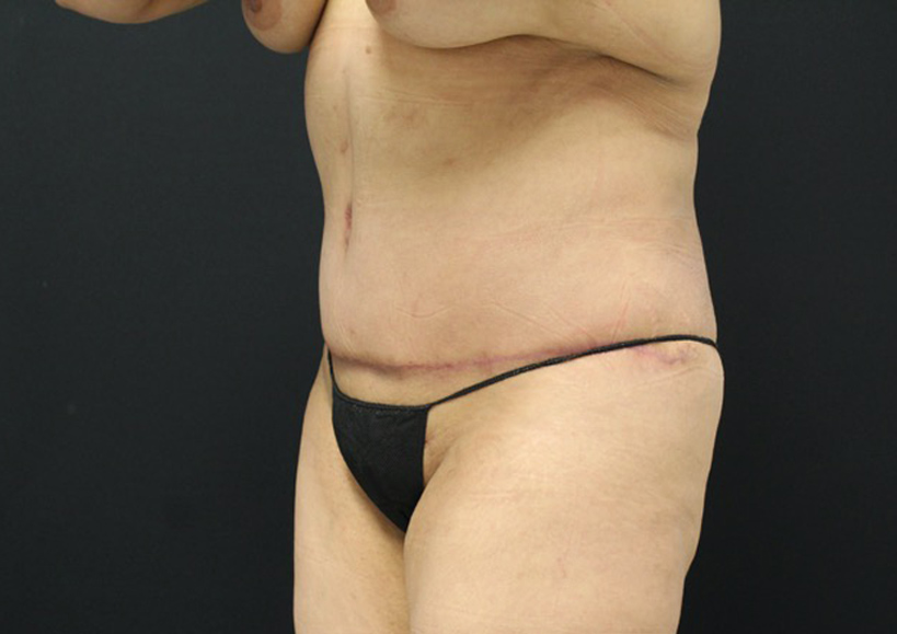 Tummy Tuck