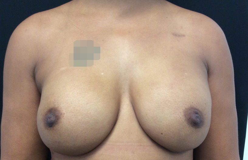 Breast Reconstruction