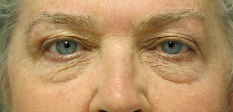 Blepharoplasty