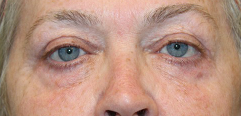 Blepharoplasty