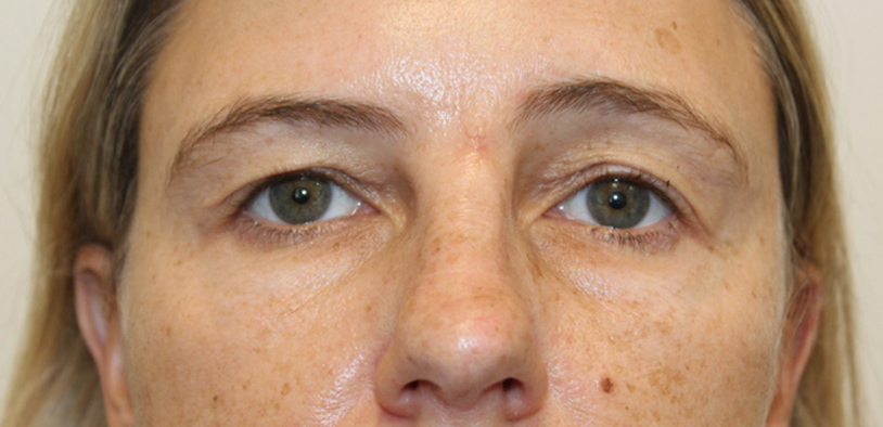 Blepharoplasty