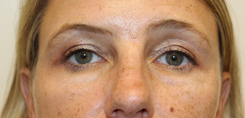 Blepharoplasty