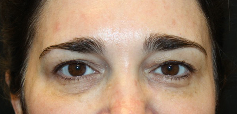 Blepharoplasty