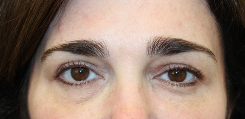 Blepharoplasty