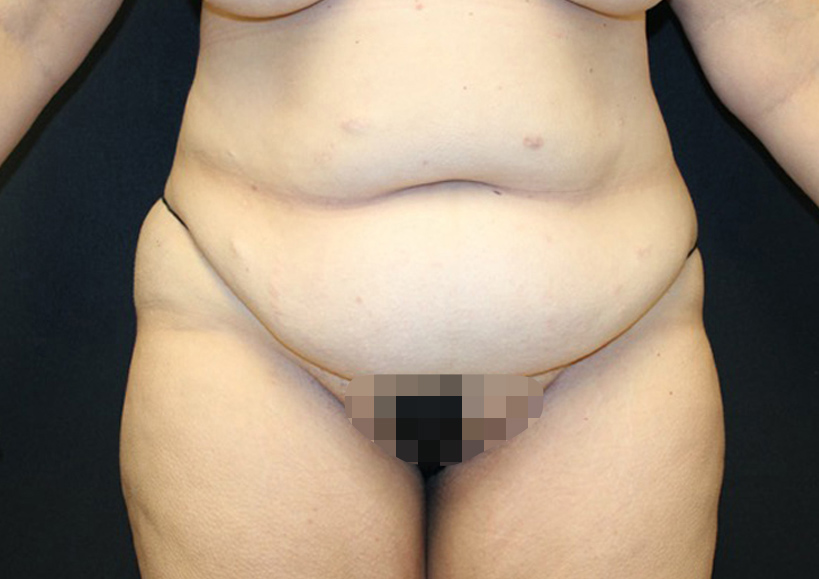 Tummy Tuck