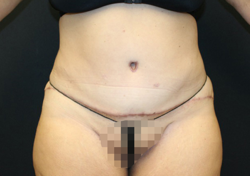 Tummy Tuck