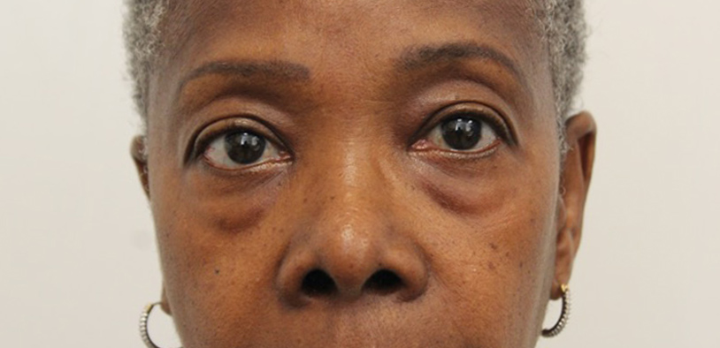 Blepharoplasty