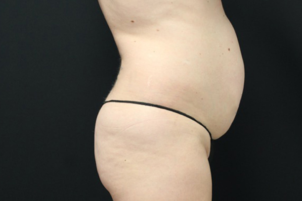 Liposuction