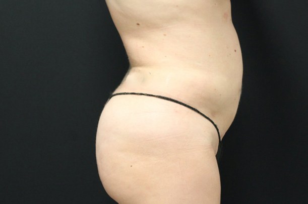 Liposuction