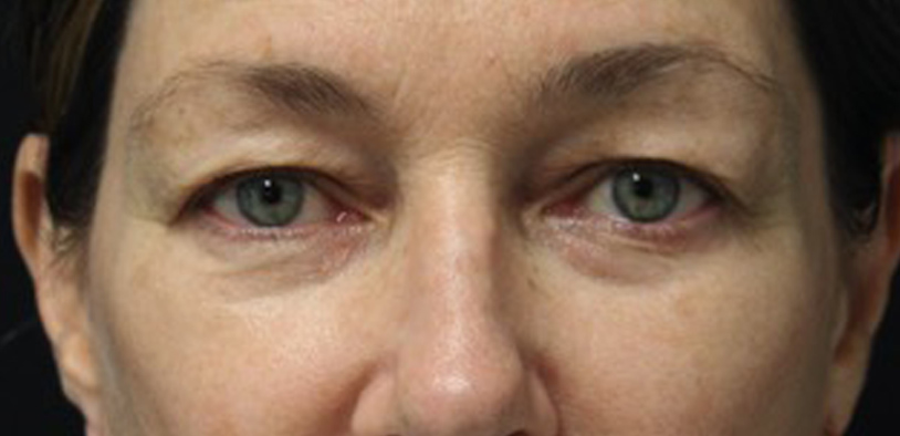 Blepharoplasty