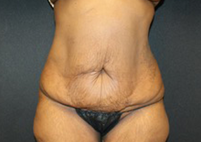 Tummy Tuck