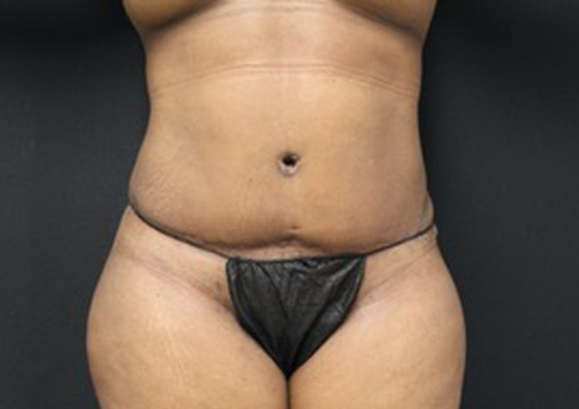 Tummy Tuck