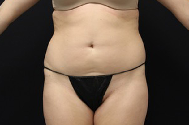 Liposuction