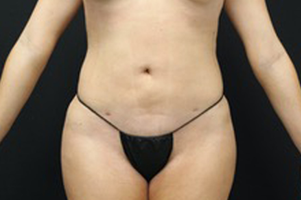 Liposuction