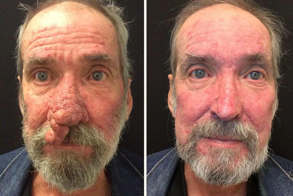 Real patient before and after Mohs Skin Cancer Reconstruction