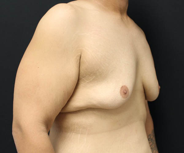 Gynecomastia