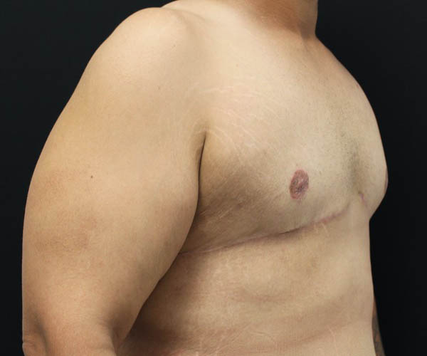 Gynecomastia