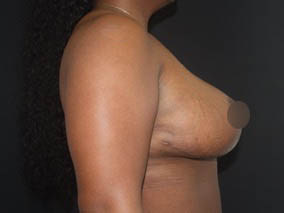 Breast Reduction