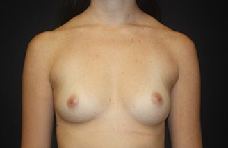 Breast Augmentation